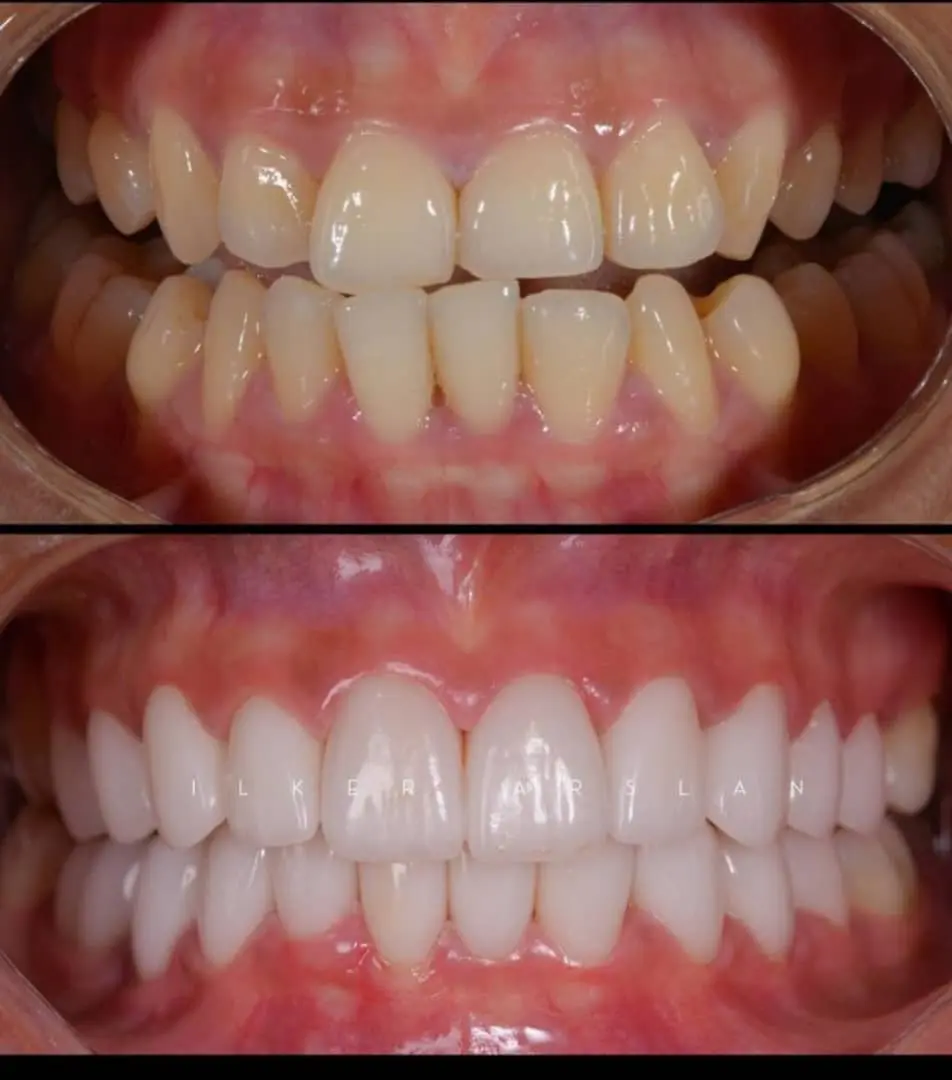 blanchiment dentaire au cabinet dentaire du golf cdg