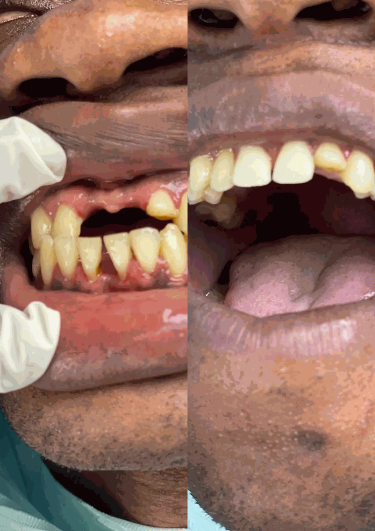 prothese dentaire au cabinet dentaire du golf cdg 