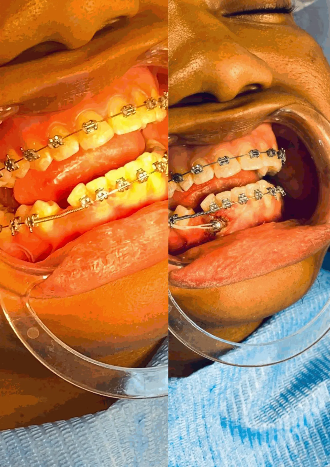 appareil dentaire ortodhontique posé au cabinet dentaire du golf cdg en rdc