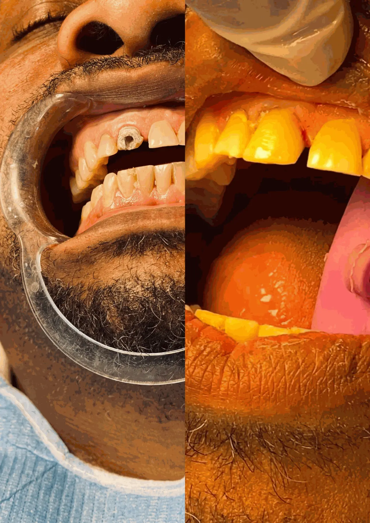 obturation dentaire au cabinet dentaire du golf cdg en rdc